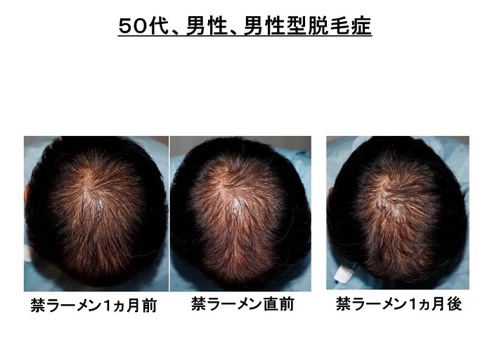 円形脱毛症　病院